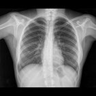 Chest (X-ray)
