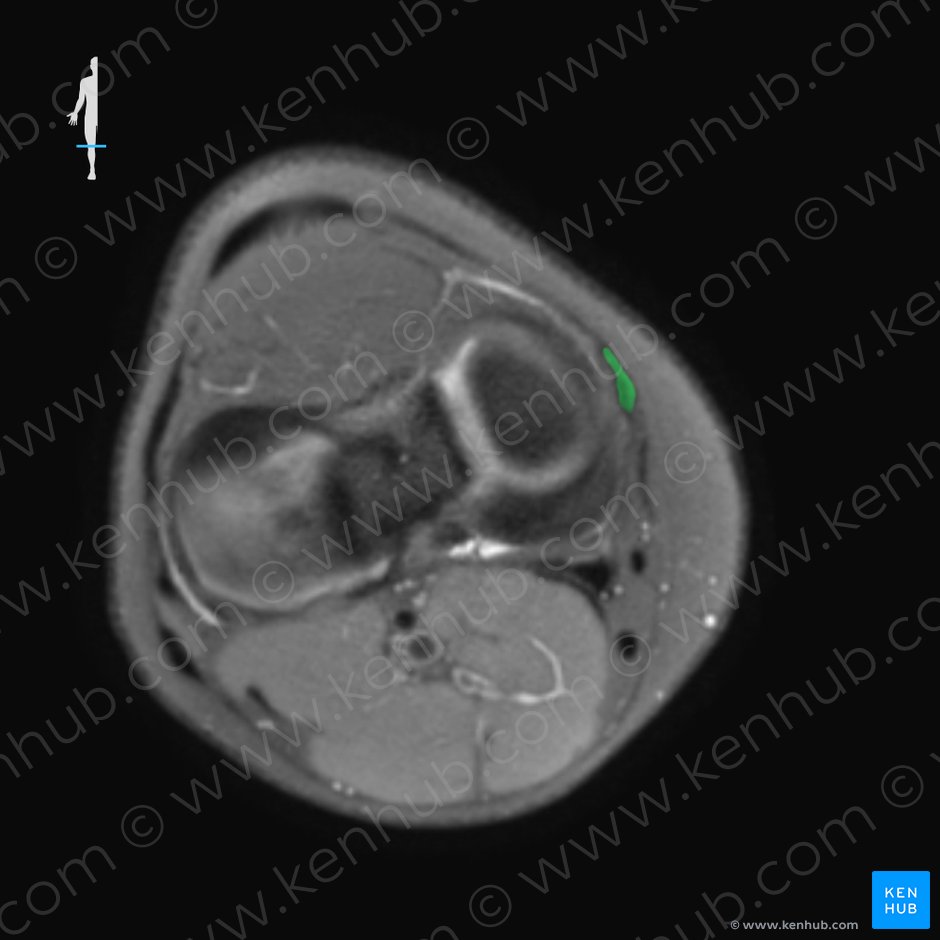 Ligamento colateral tibial de la articulación de la rodilla (Ligamentum collaterale tibiale genus); Imagen: 