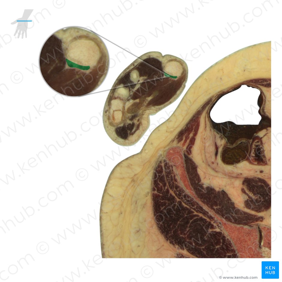 Tendon of flexor pollicis longus muscle (Tendo musculi flexoris pollicis longi); Image: National Library of Medicine