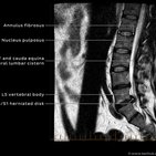 Clinical case: Radiculopathy and surgical treatment