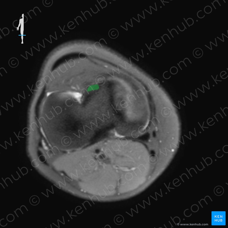 Ligamento cruzado anterior (Ligamentum cruciatum anterius); Imagen: 
