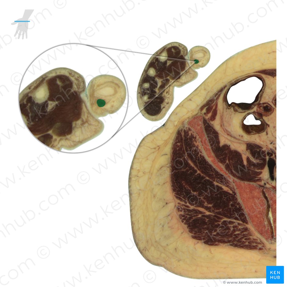 Tendon of flexor pollicis longus muscle (Tendo musculi flexoris pollicis longi); Image: National Library of Medicine