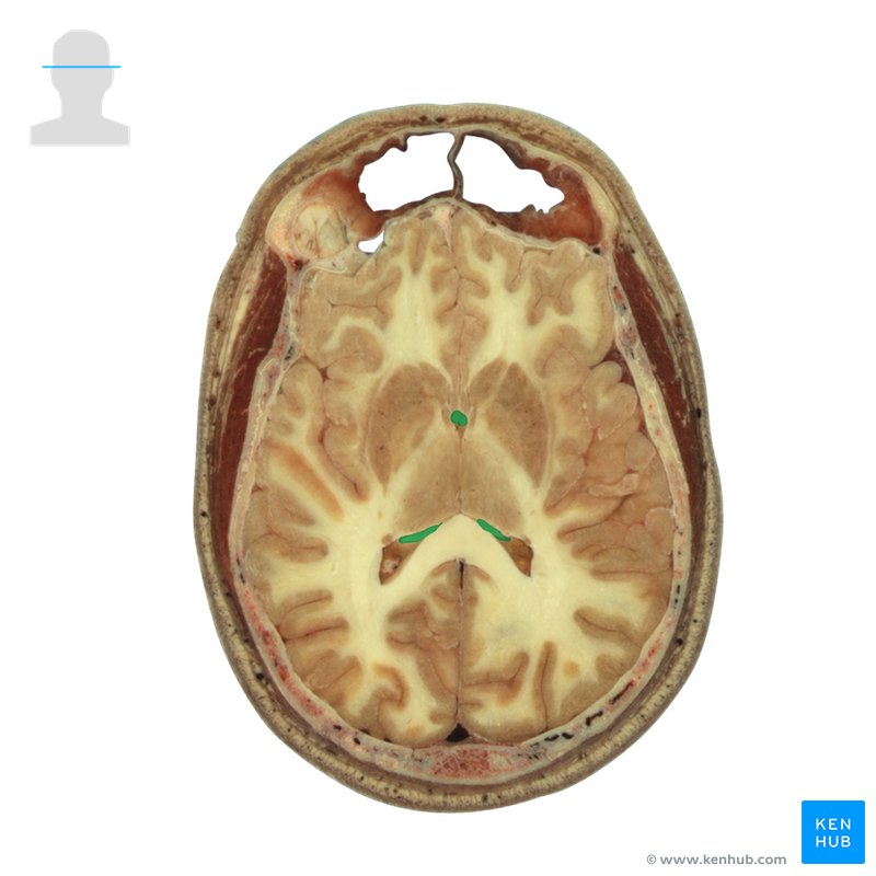 Horizontal sections of the brain: Anatomy | Kenhub