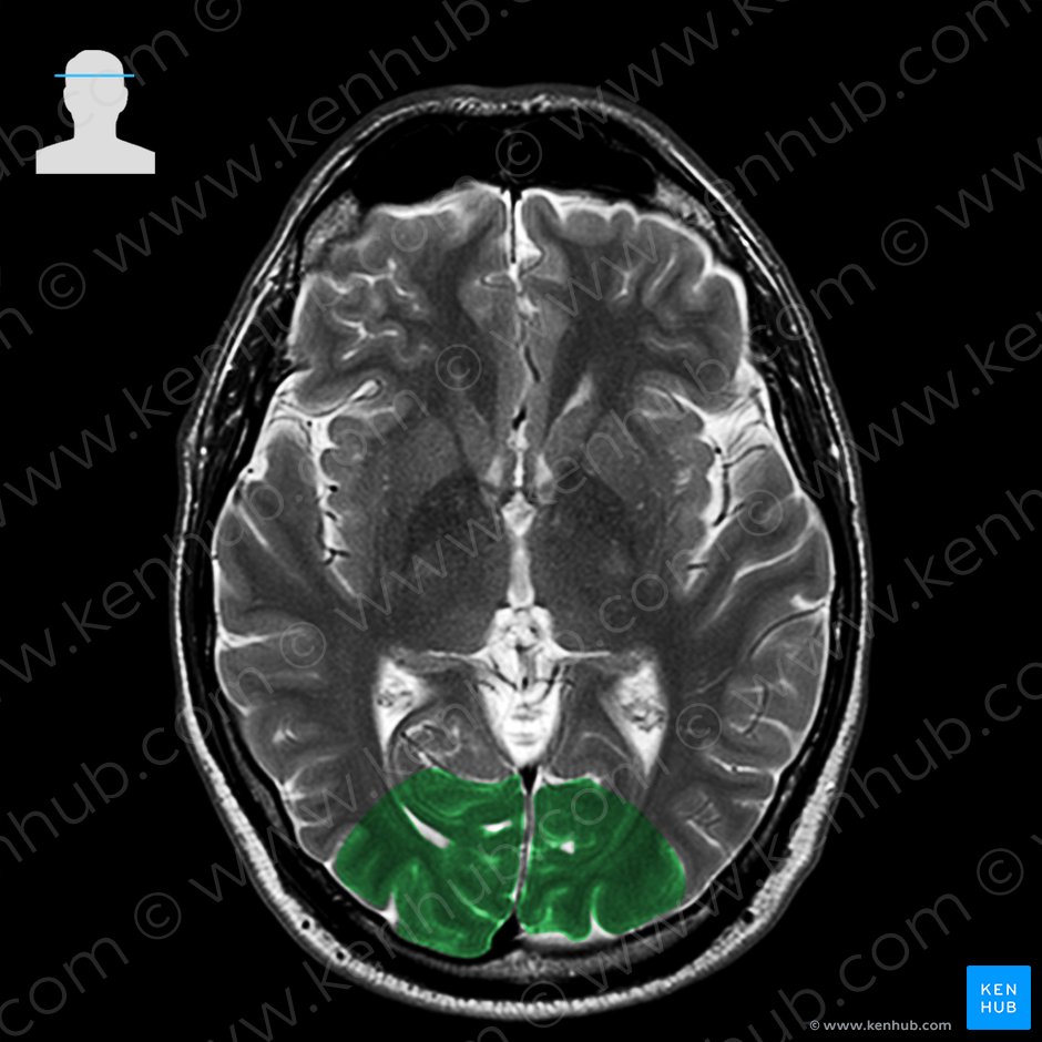 Occipital lobe (Lobus occipitalis); Image: 