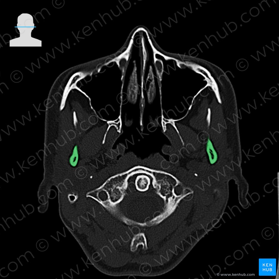 Processus condylaris mandibulae (Gelenkfortsatz des Unterkieferknochens); Bild: 