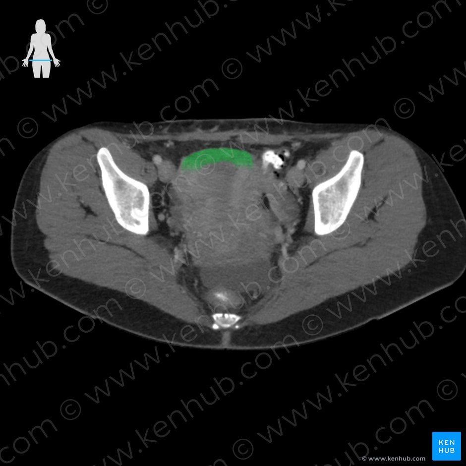 Fundus of uterus (Fundus uteri); Image: 