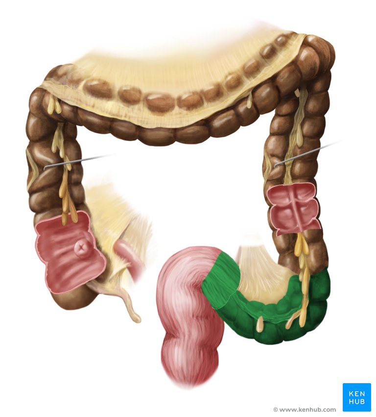 large intestine excised with sigmoid colon highlighted