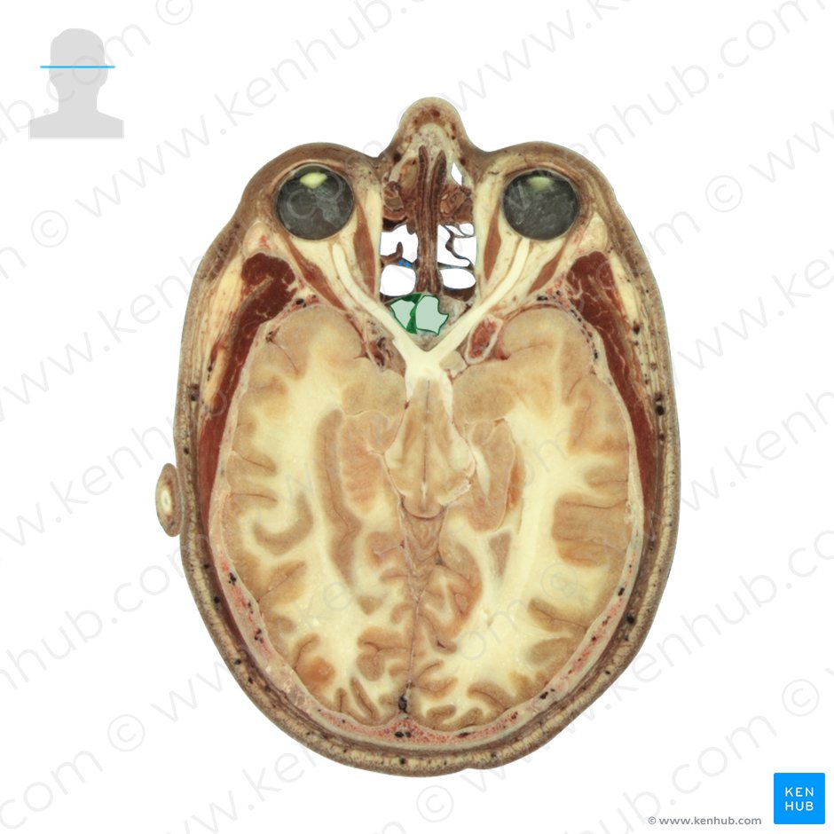 Sphenoidal sinus (Sinus sphenoidalis); Image: National Library of Medicine