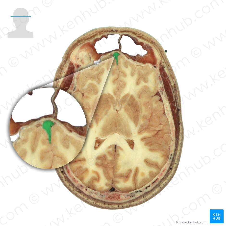 Crista galli of ethmoid bone (Crista galli ossis ethmoidalis); Image: National Library of Medicine