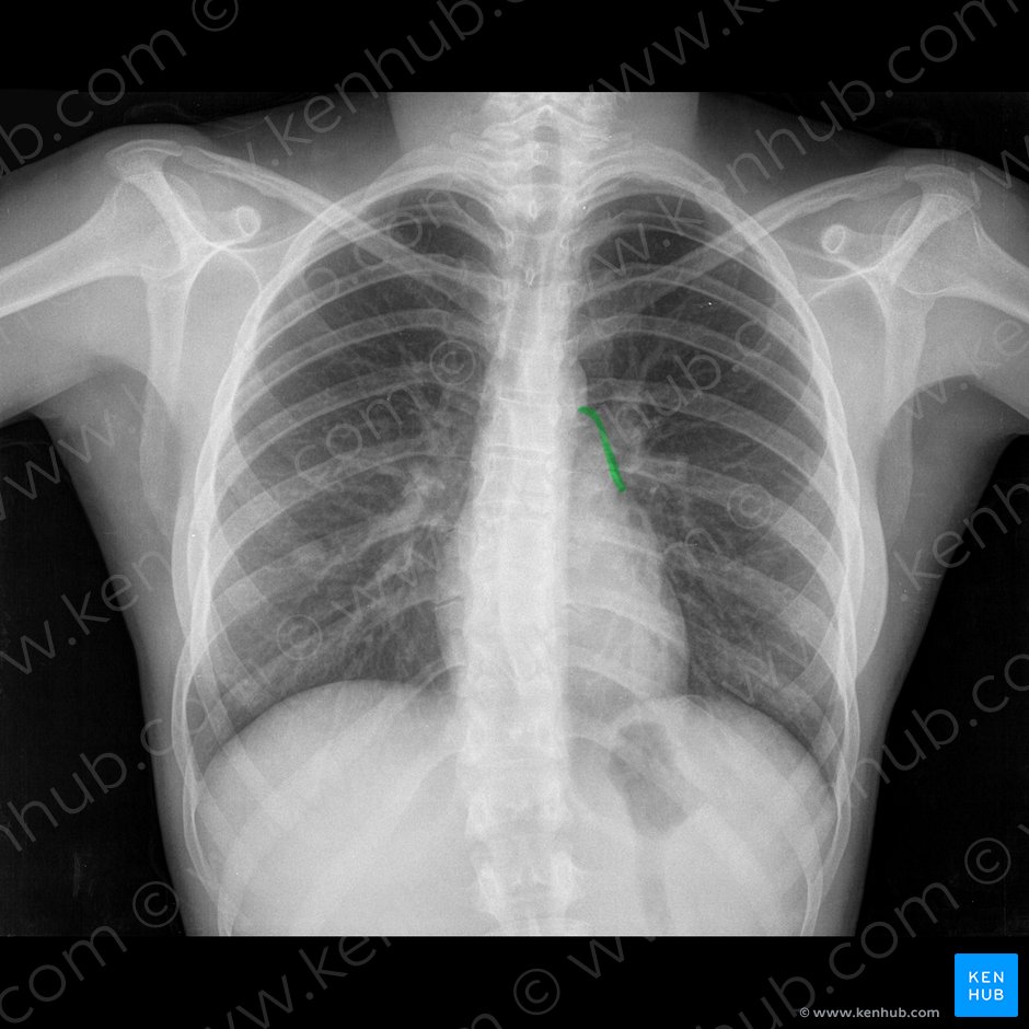 Border of pulmonary trunk (Margo trunci pulmonalis); Image: 