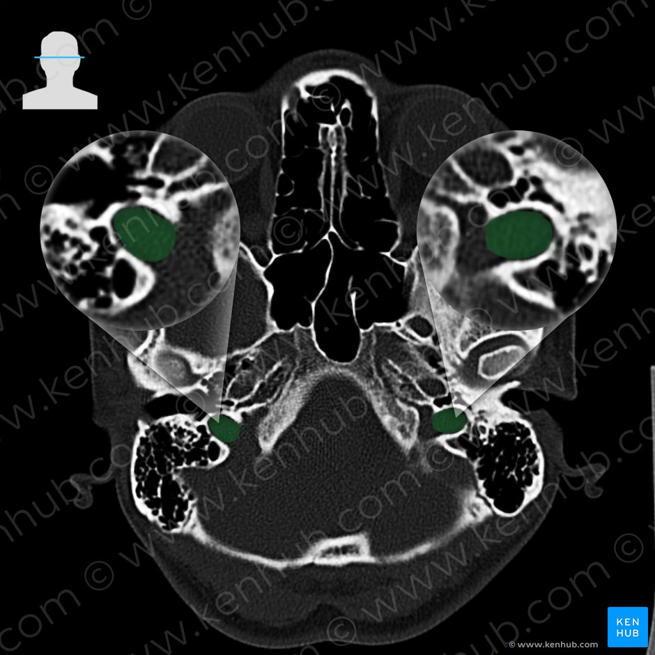 Jugular fossa of temporal bone (Fossa jugularis ossis temporalis); Image: 