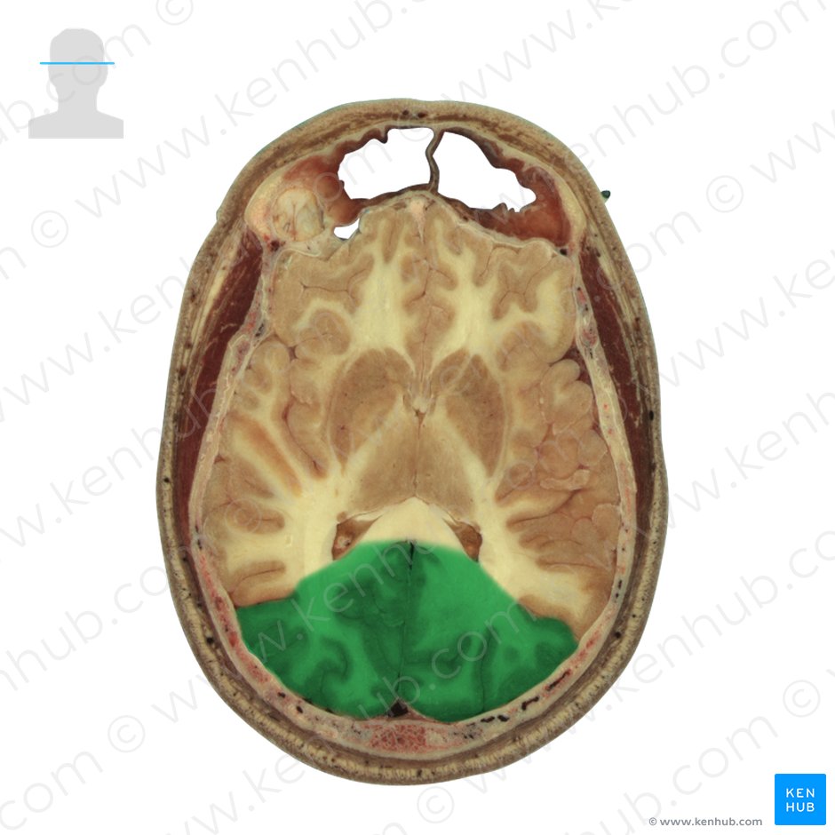 Occipital lobe (Lobus occipitalis); Image: National Library of Medicine