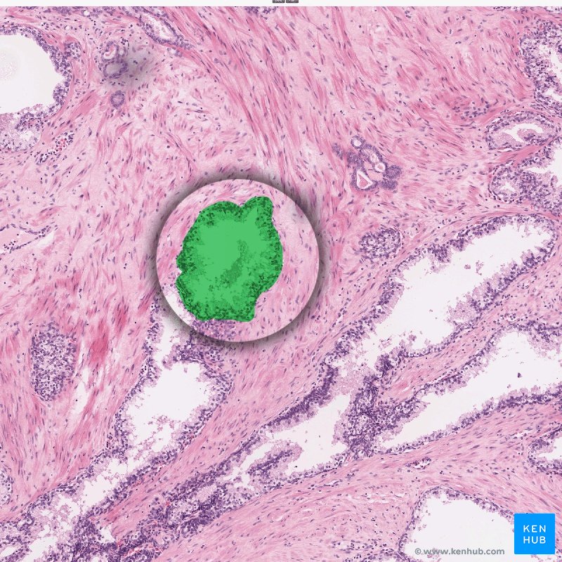 Papillary urothelial carcinoma histopathology - Much more than documents.