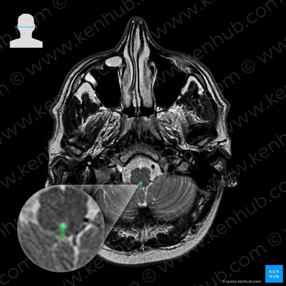 Median aperture of fourth ventricle (Apertura mediana ventriculi quarti); Image: 