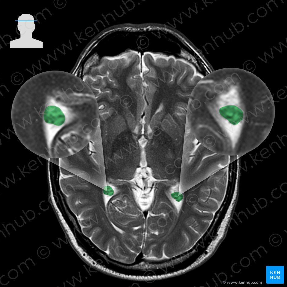 Choroid plexus of lateral ventricle (Plexus choroideus ventriculi lateralis); Image: 