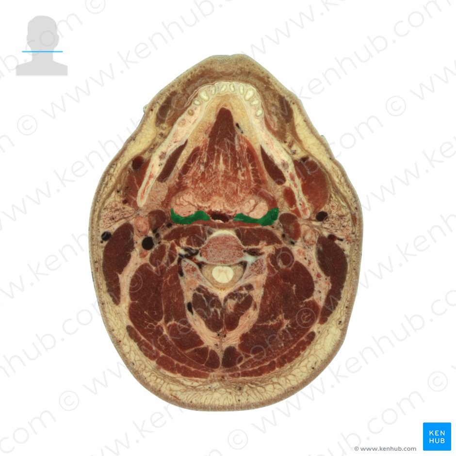 Músculo palatofaríngeo (Musculus palatopharyngeus); Imagem: National Library of Medicine
