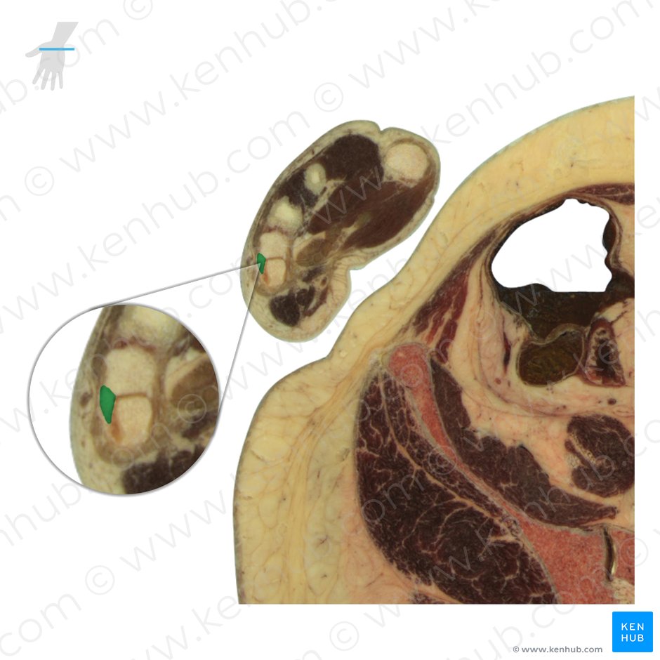 Hamate bone (Os hamatum); Image: National Library of Medicine