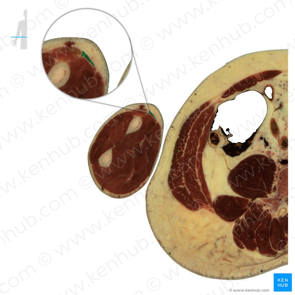 Músculo braquiorradial (Musculus brachioradialis); Imagem: National Library of Medicine