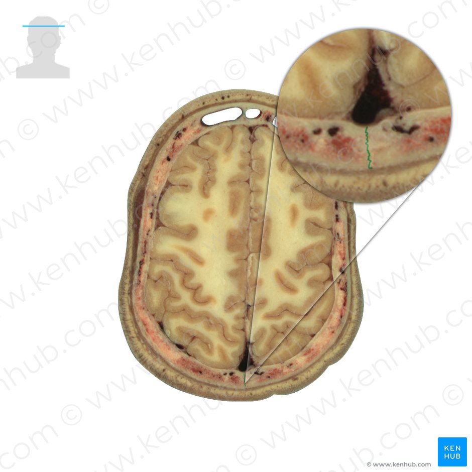 Sagittal suture (Sutura sagittalis); Image: National Library of Medicine