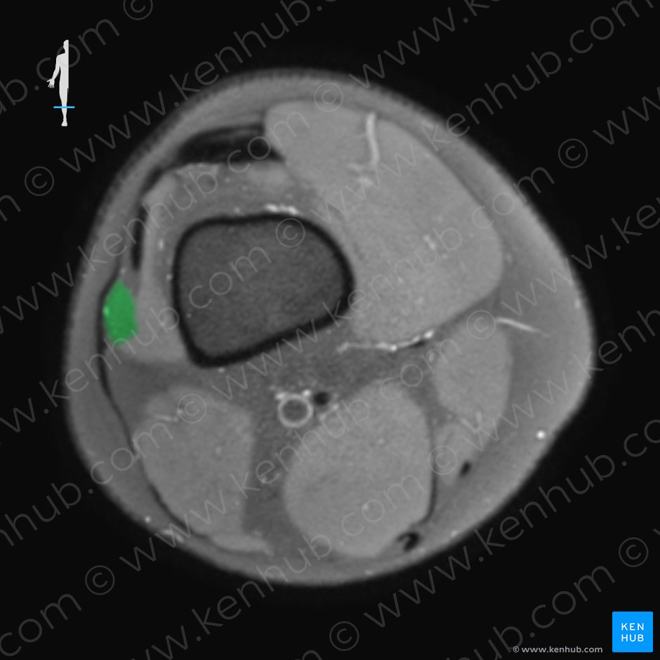 Músculo vasto lateral (Musculus vastus lateralis); Imagen: 