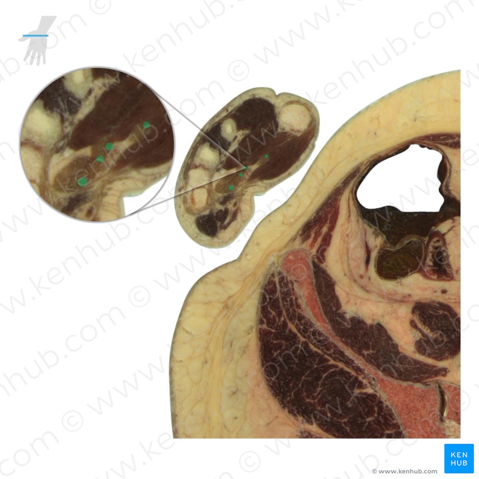 Tendons of flexor digitorum superficialis muscle (Tendines musculi flexoris digitorum superficialis); Image: National Library of Medicine