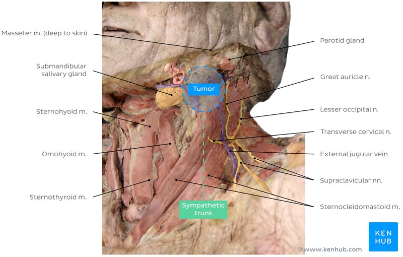 Figure 1 - Cadaver image - Location of the tumor