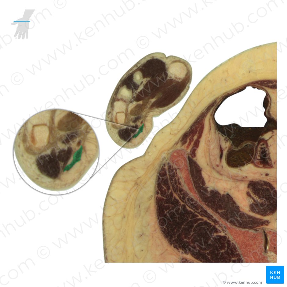 Palmaris brevis muscle (Musculus palmaris brevis); Image: National Library of Medicine