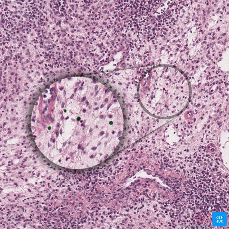 Núcleo de la célula reticular; Imagen: 