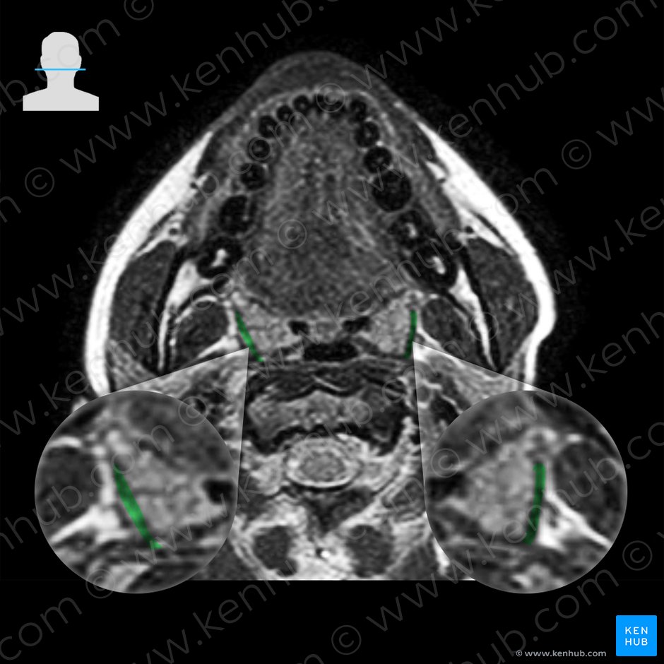 Superior pharyngeal constrictor muscle (Musculus constrictor pharyngis superior); Image: 