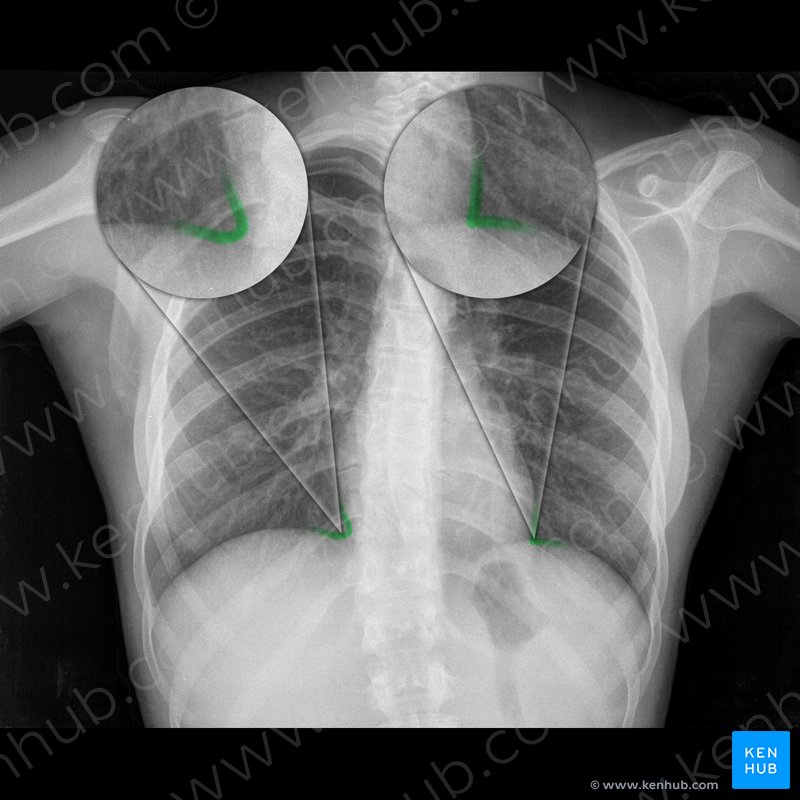 Normal chest x-ray: Anatomy tutorial | Kenhub