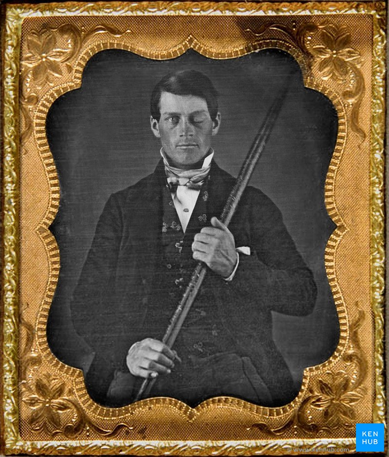 Phineas Gage - Injury of the prefrontal cortex
