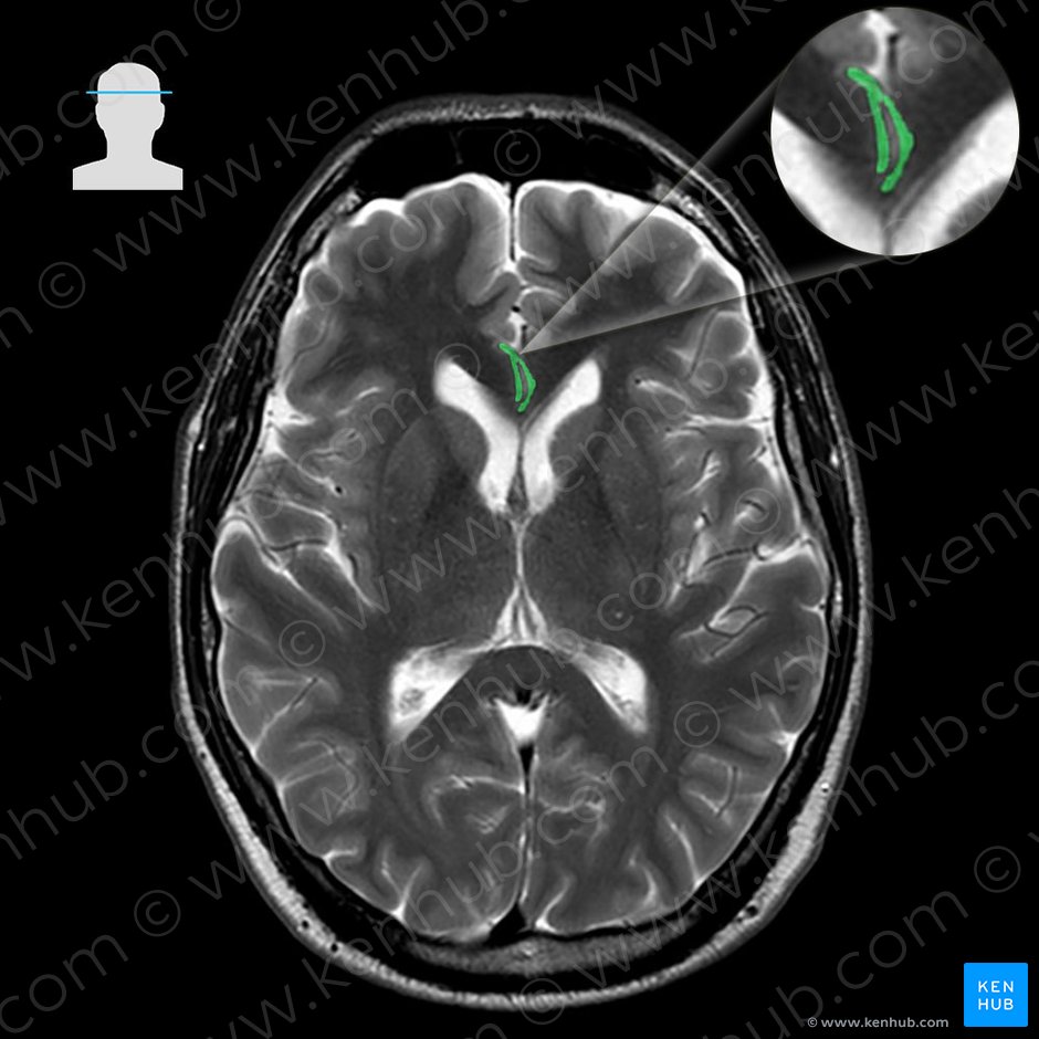Anterior cerebral artery (Arteria anterior cerebri); Image: 