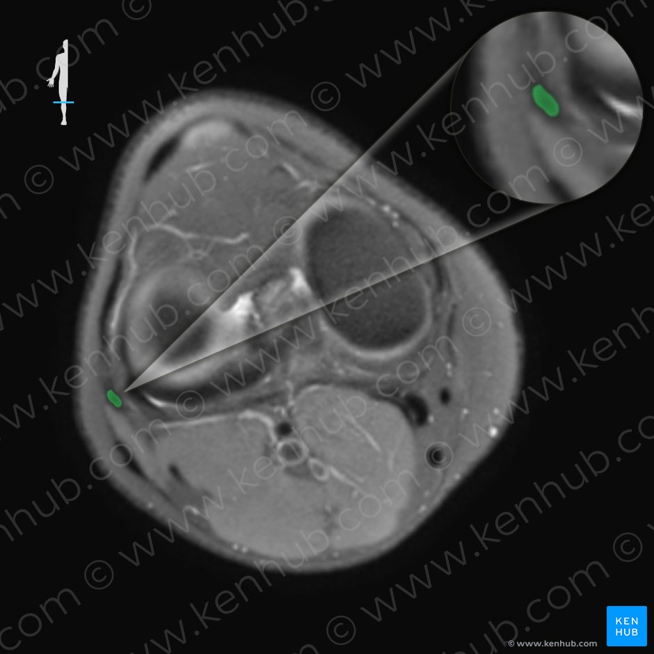 Ligamento colateral fibular de la articulación de la rodilla (Ligamentum collaterale fibulare genus); Imagen: 