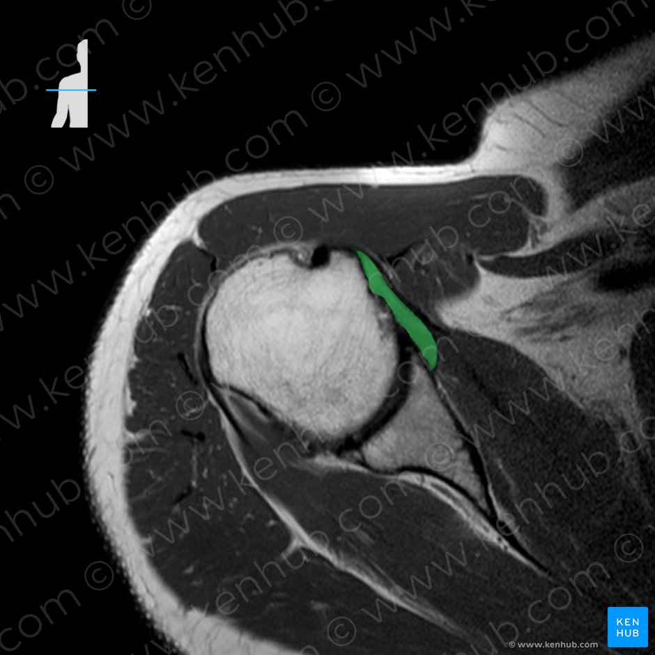 Glenohumeral ligaments (Ligamenta glenohumeralia); Image: 