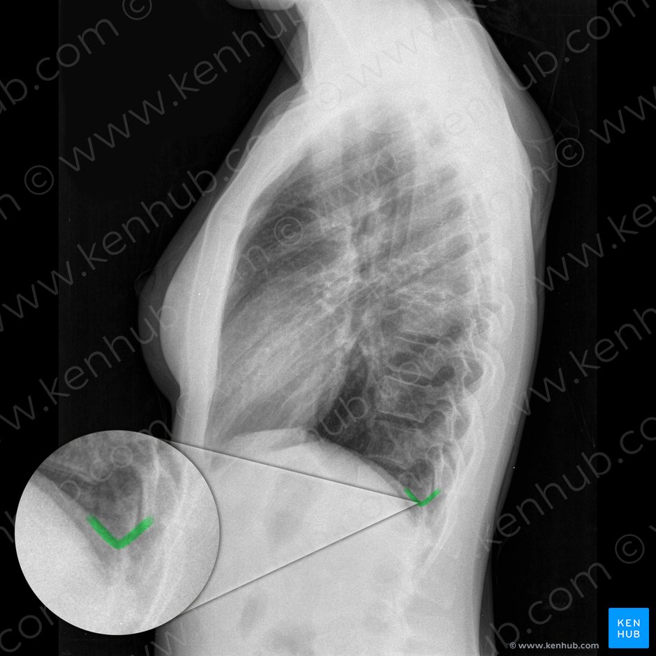 Left posterior costophrenic angle (Angulus costophrenicus posterior sinister); Image: 