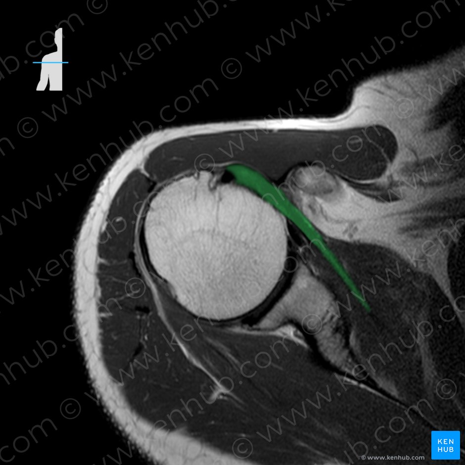 Tendon of subscapularis muscle (Tendo musculi subscapularis); Image: 