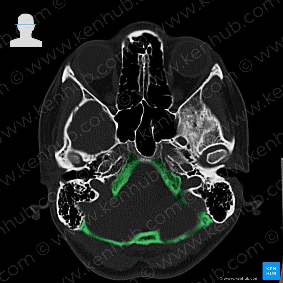 Occipital bone (Os occipitale); Image: 