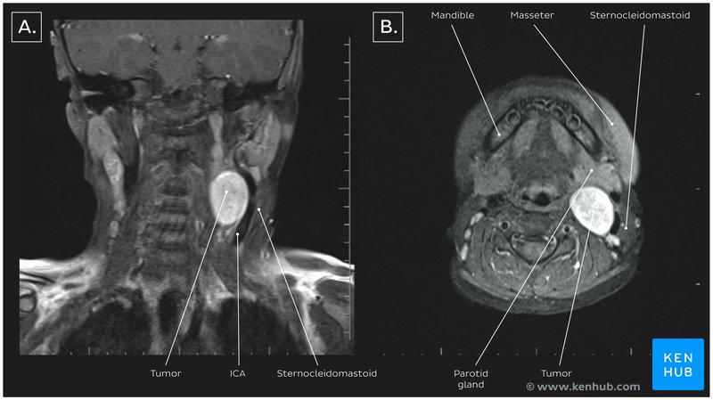 Figure 2 - A. Coronal MRI showing tumor. B. Axial MRI showing tumor