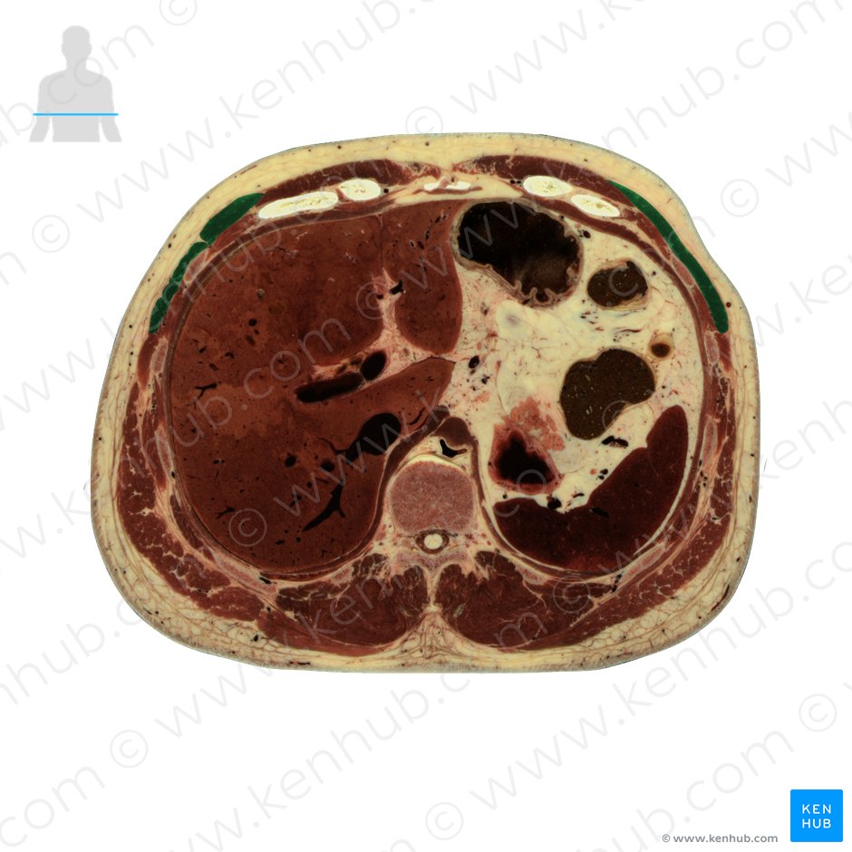 External abdominal oblique muscle (Musculus obliquus externus abdominis); Image: National Library of Medicine