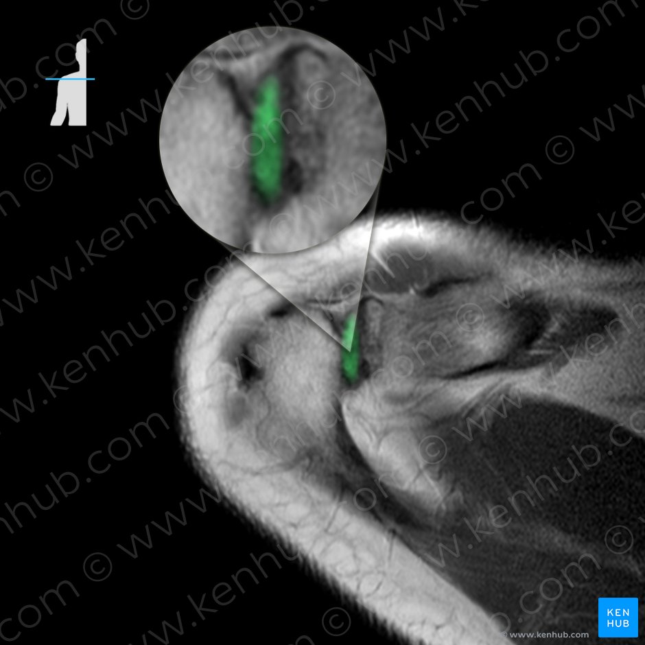 Acromioclavicular joint (Articulatio acromioclavicularis); Image: 