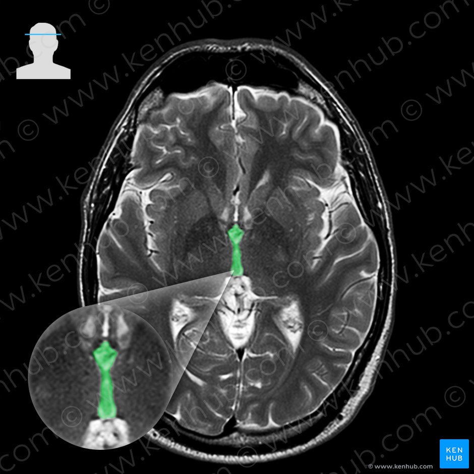 Third ventricle (Ventriculus tertius); Image: 