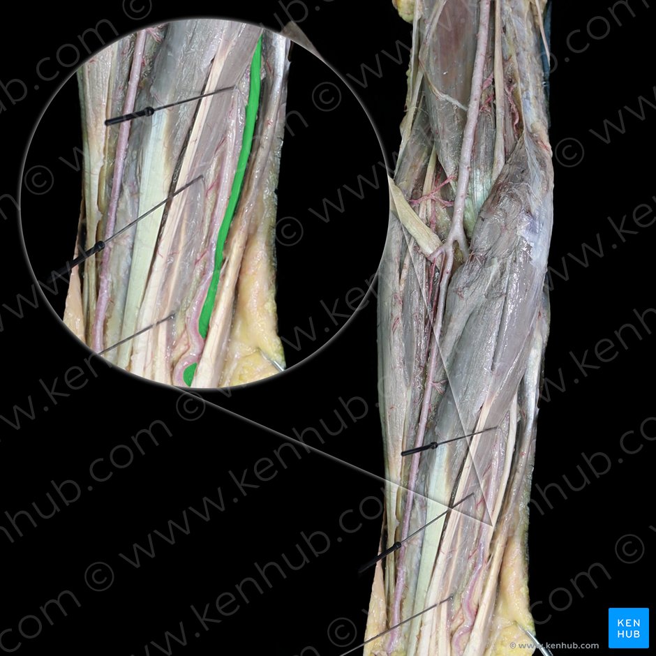 Ulnar nerve (Nervus ulnaris); Image: 