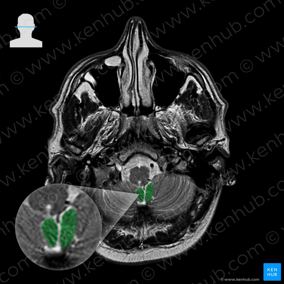 Tonsil of cerebellum (Tonsilla cerebelli); Image: 