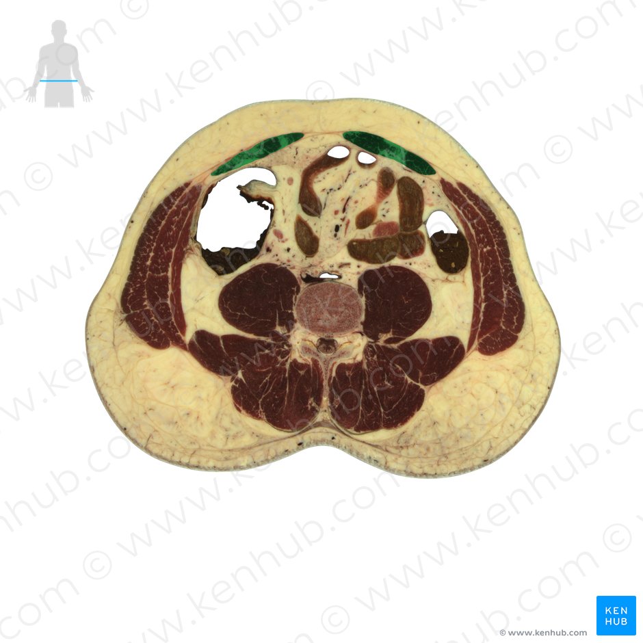Músculo reto do abdome (Musculus rectus abdominis); Imagem: National Library of Medicine