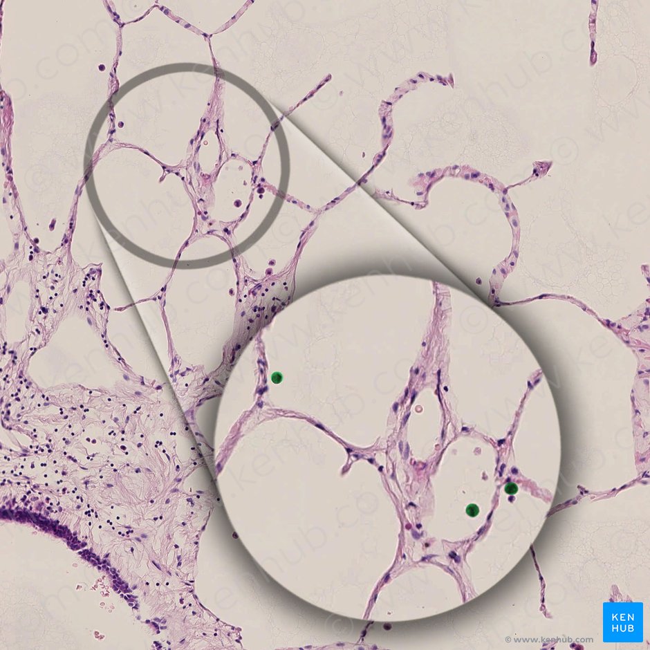 Macrophagocytus alveolaris (Alveolarmakrophage); Bild: 