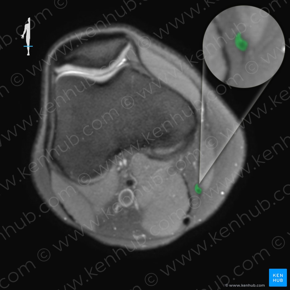Tendon of gracilis muscle (Tendo musculi gracilis); Image: 