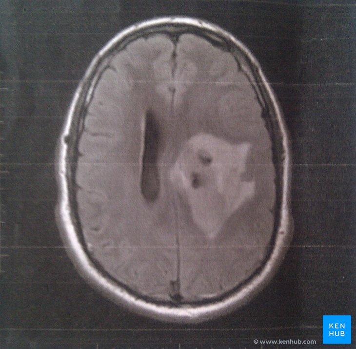 RM de um tumor cerebral