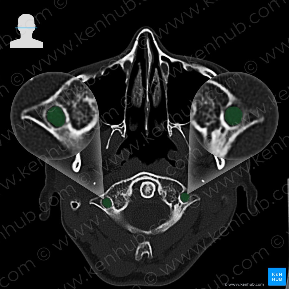 Transverse foramen of vertebra (Foramen transversarium vertebrae); Image: 