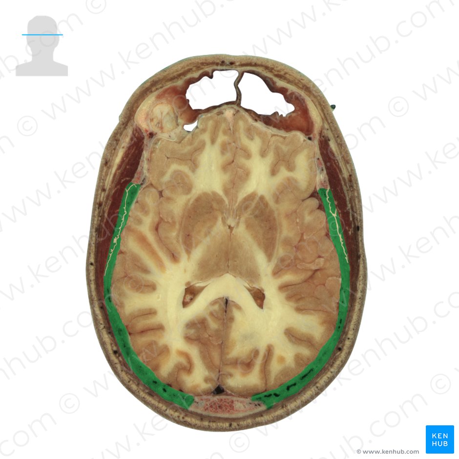 Parietal bone (Os parietale); Image: National Library of Medicine