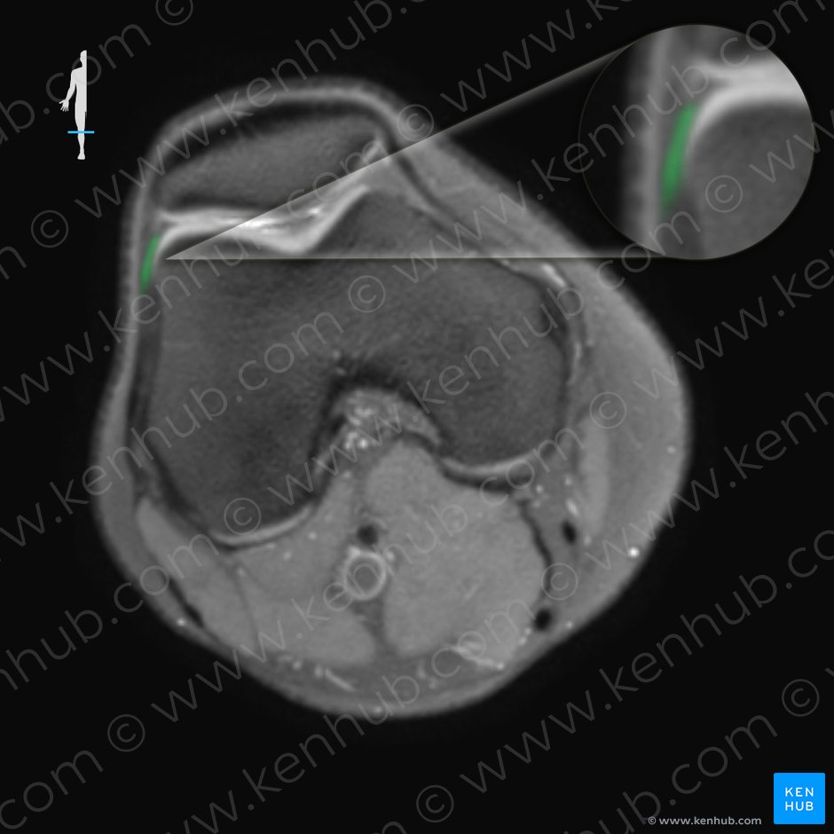Retináculo patelar lateral (Retinaculum patellae laterale); Imagen: 